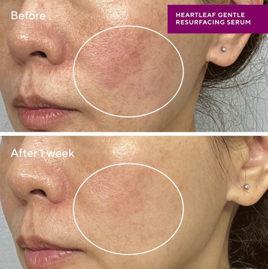 Heartleaf Resurfacing Serum