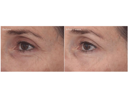 Retinal ReSculpt Eye Treatment